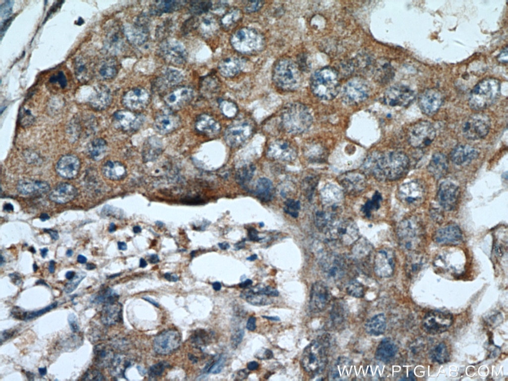 IHC staining of human breast cancer using 14139-1-AP