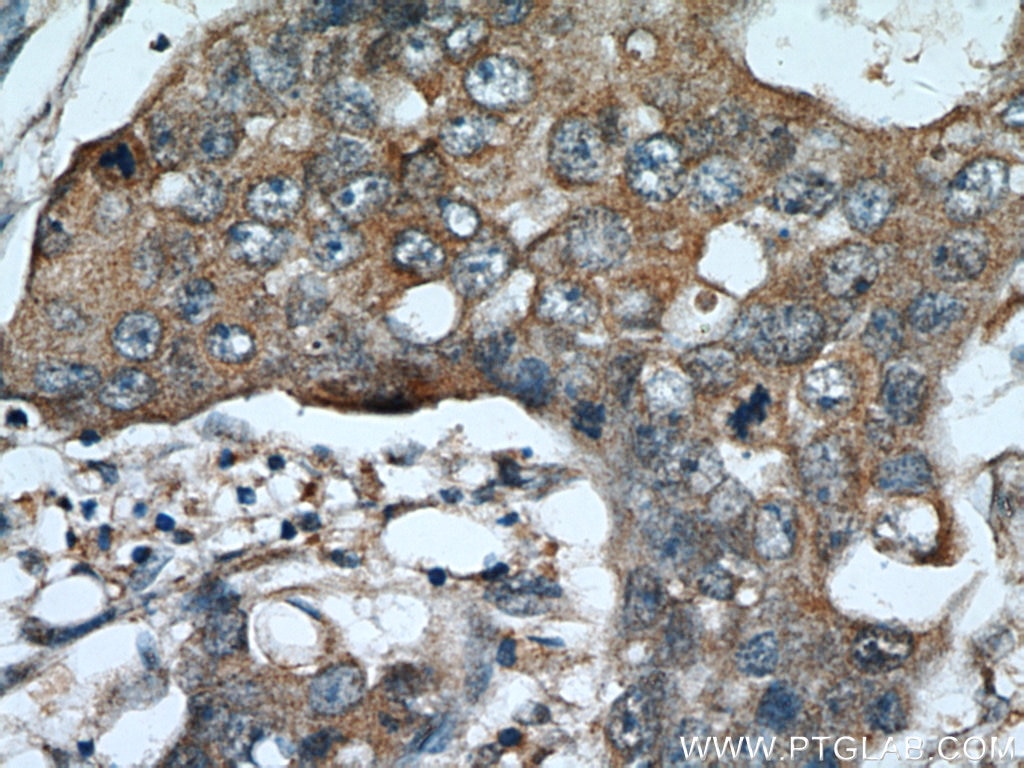 Immunohistochemistry (IHC) staining of human breast cancer tissue using ADAM12 Polyclonal antibody (14139-1-AP)