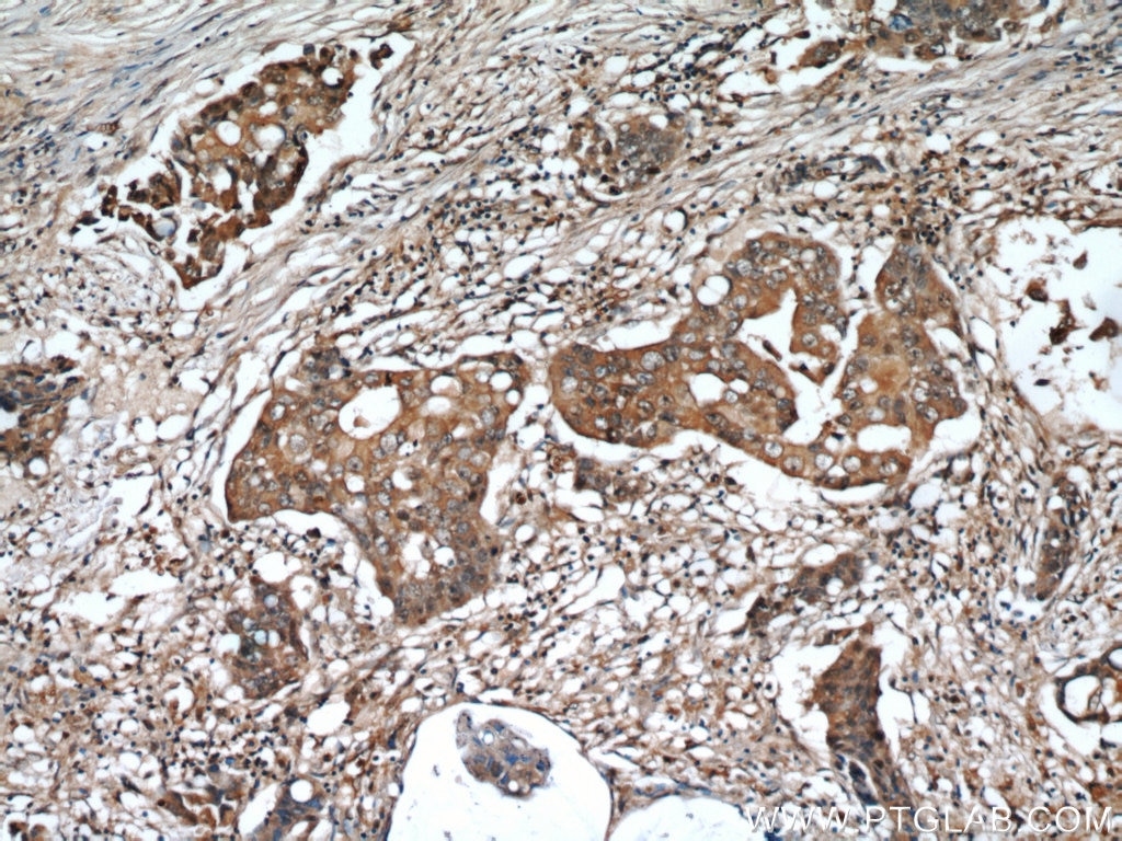 Immunohistochemistry (IHC) staining of human breast cancer tissue using ADAM12 Polyclonal antibody (14139-1-AP)