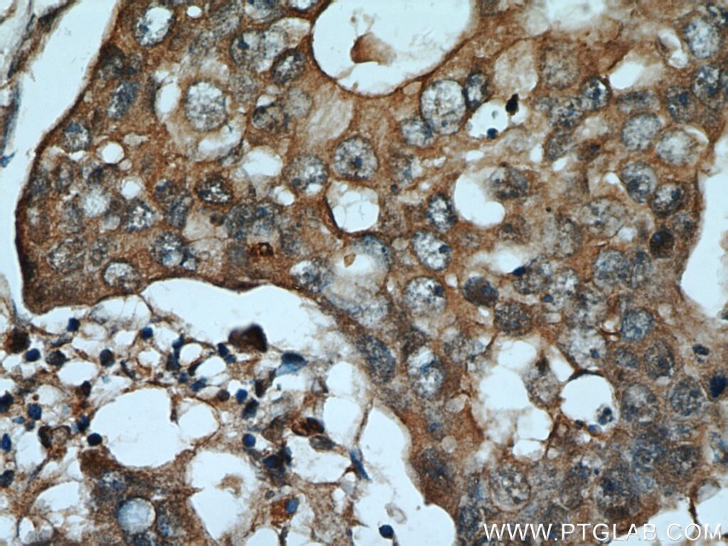 Immunohistochemistry (IHC) staining of human breast cancer tissue using ADAM12 Polyclonal antibody (14139-1-AP)