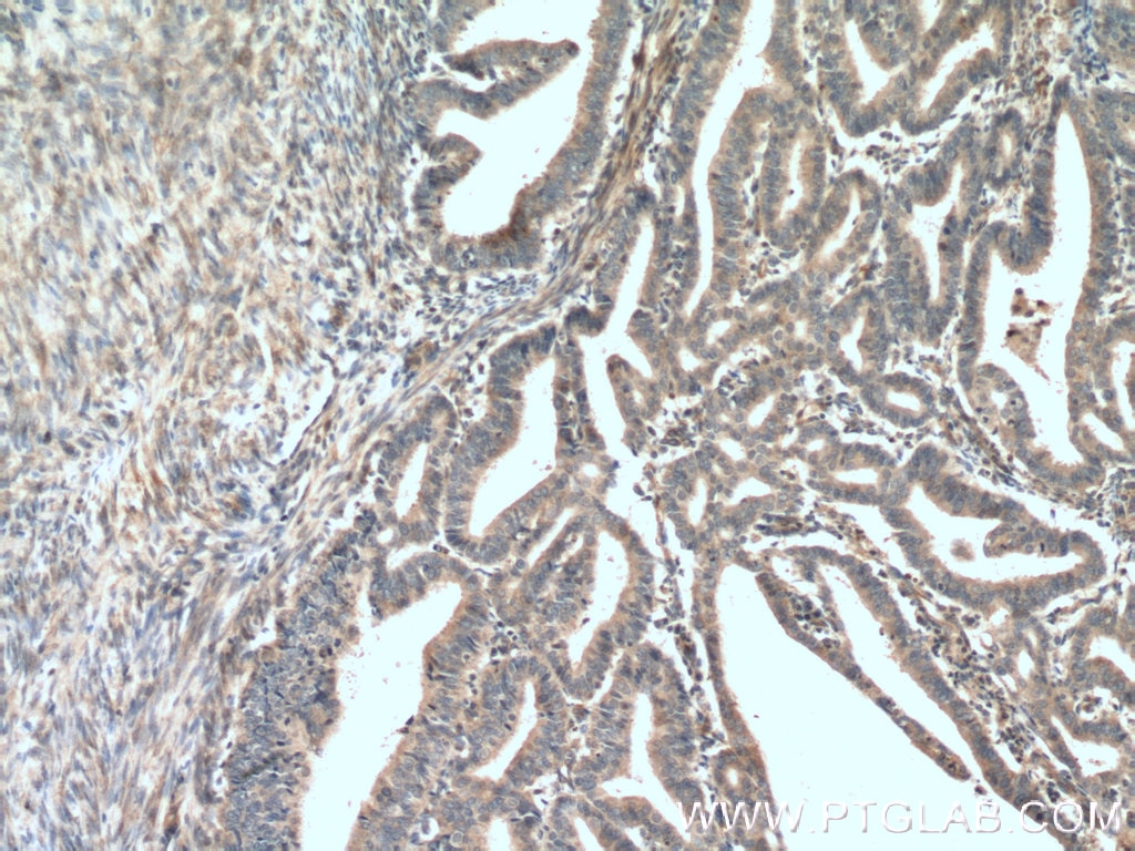 Immunohistochemistry (IHC) staining of human endometrial cancer tissue using ADAM12 Polyclonal antibody (26928-1-AP)