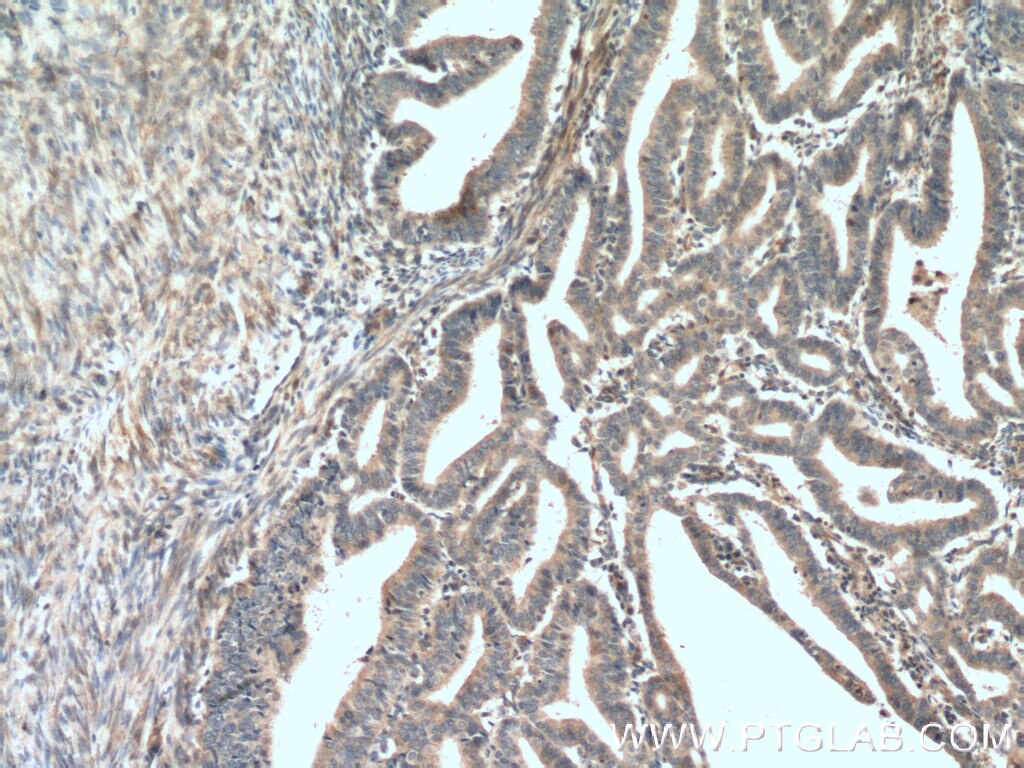 Immunohistochemistry (IHC) staining of human endometrial cancer tissue using ADAM12 Polyclonal antibody (26928-1-AP)