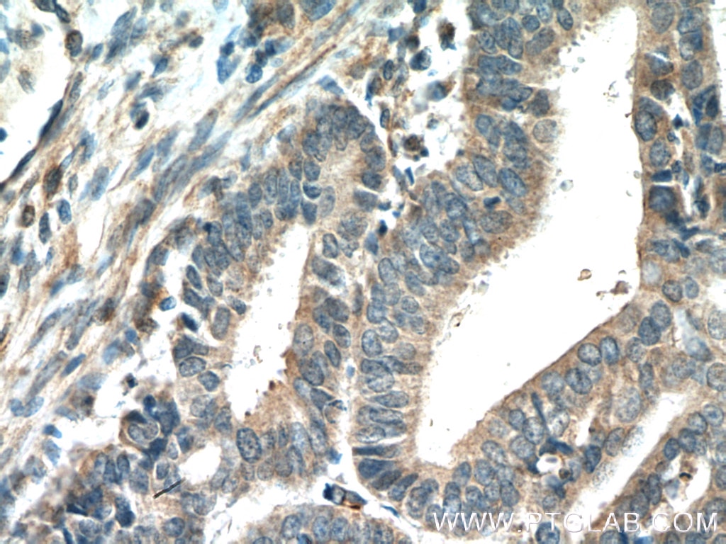 Immunohistochemistry (IHC) staining of human endometrial cancer tissue using ADAM12 Polyclonal antibody (26928-1-AP)