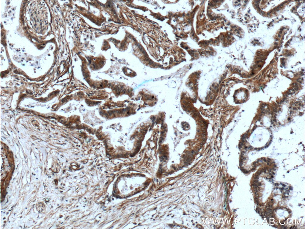 Immunohistochemistry (IHC) staining of human pancreas cancer tissue using ADAM17 Polyclonal antibody (24620-1-AP)