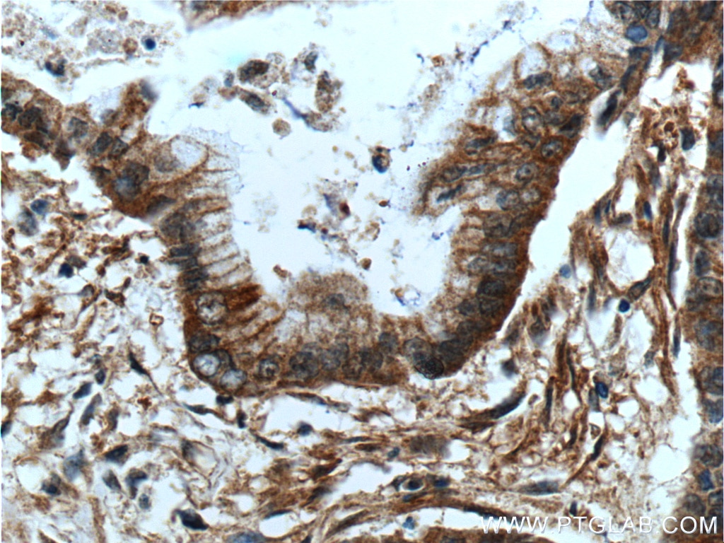 IHC staining of human pancreas cancer using 24620-1-AP
