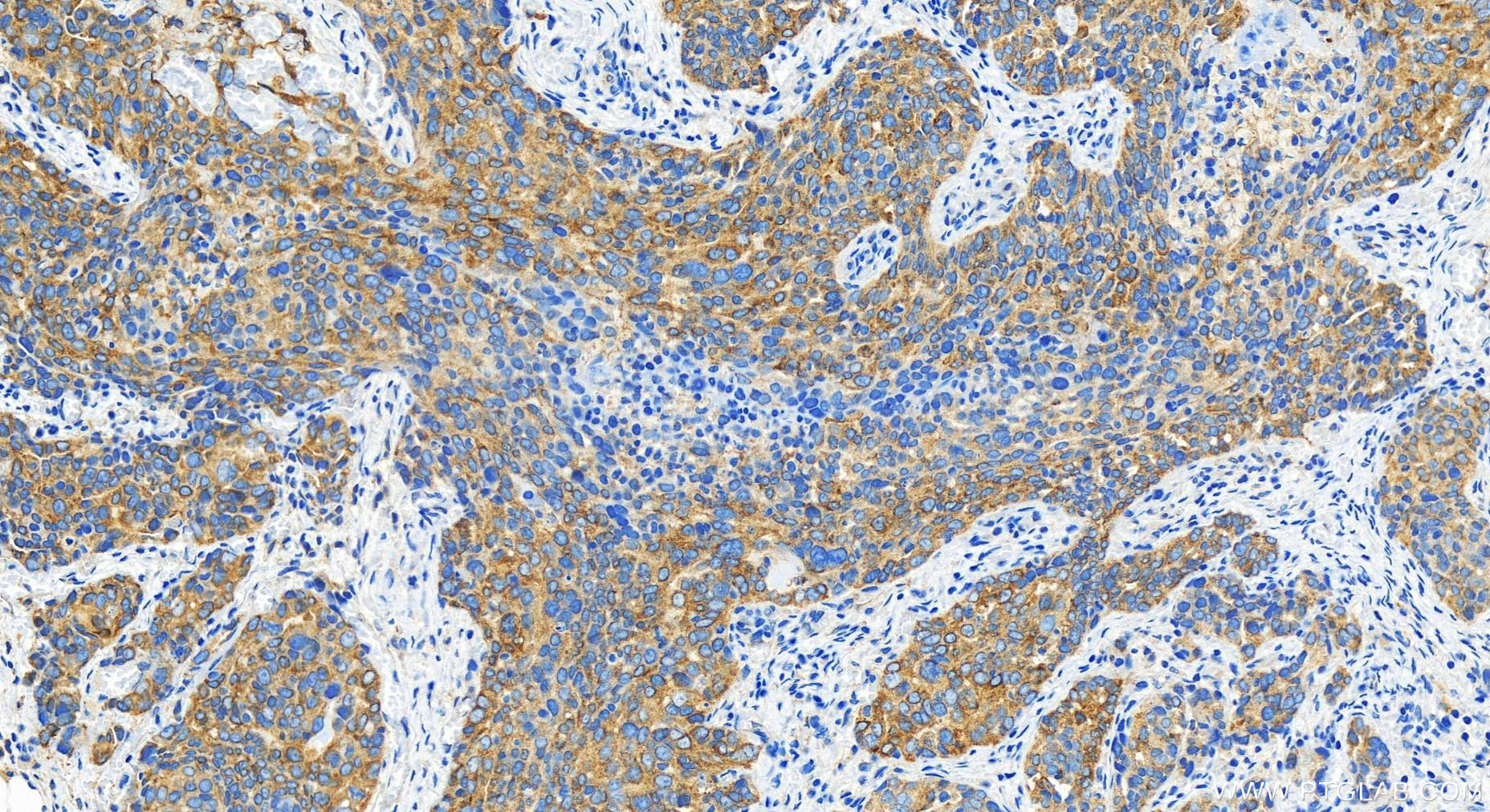 IHC staining of human ovary cancer using 29948-1-AP Immunohistochemistry (IHC) staining of human ovary cancer tissue using ADAM17 Polyclonal antibody (29948-1-AP)