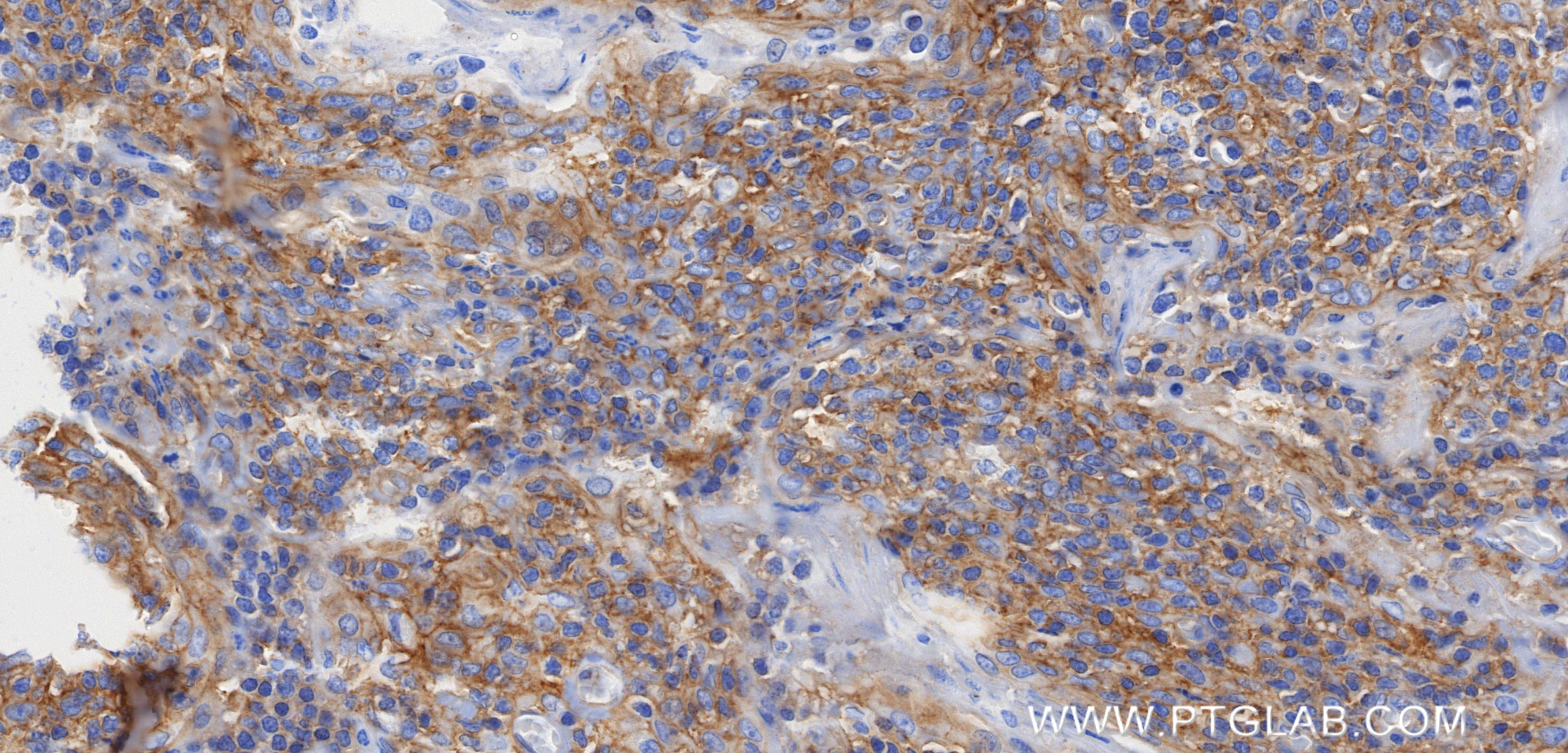 Immunohistochemistry (IHC) staining of human tonsil tissue using ADAM17 Recombinant monoclonal antibody (84292-4-RR)