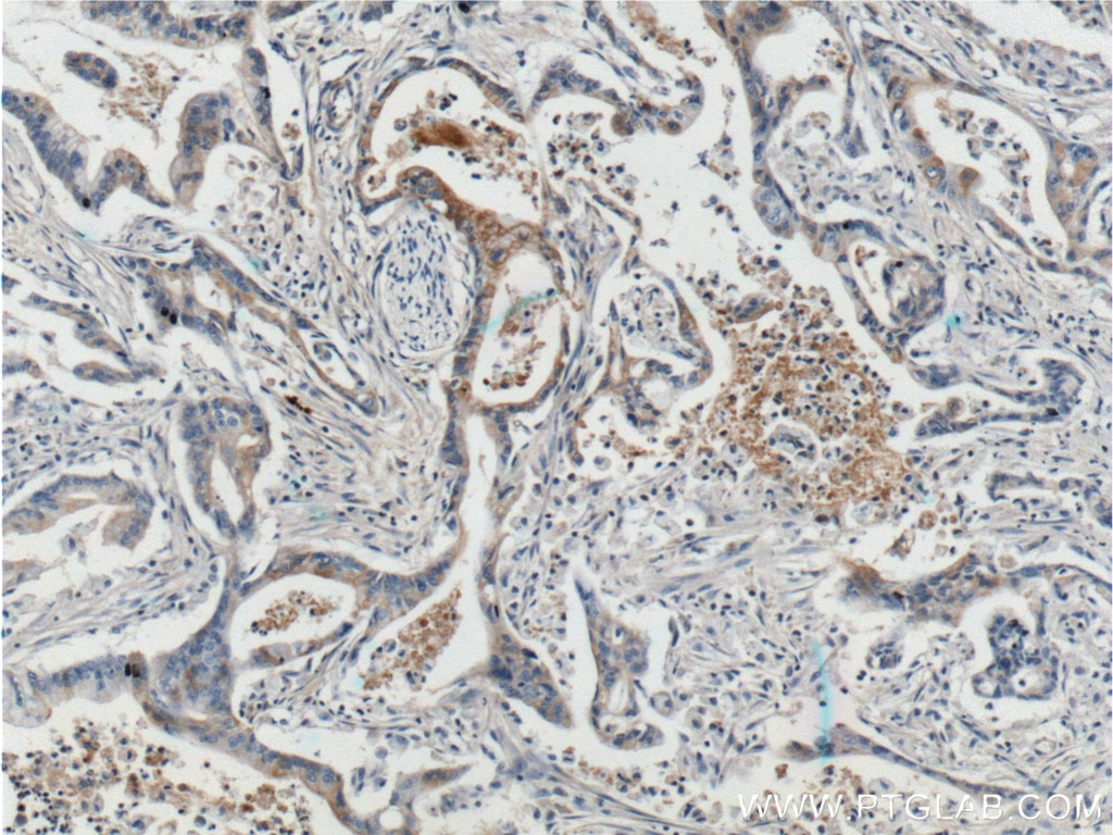 Immunohistochemistry (IHC) staining of human pancreas cancer tissue using ADAM17-Specific Polyclonal antibody (20259-1-AP)