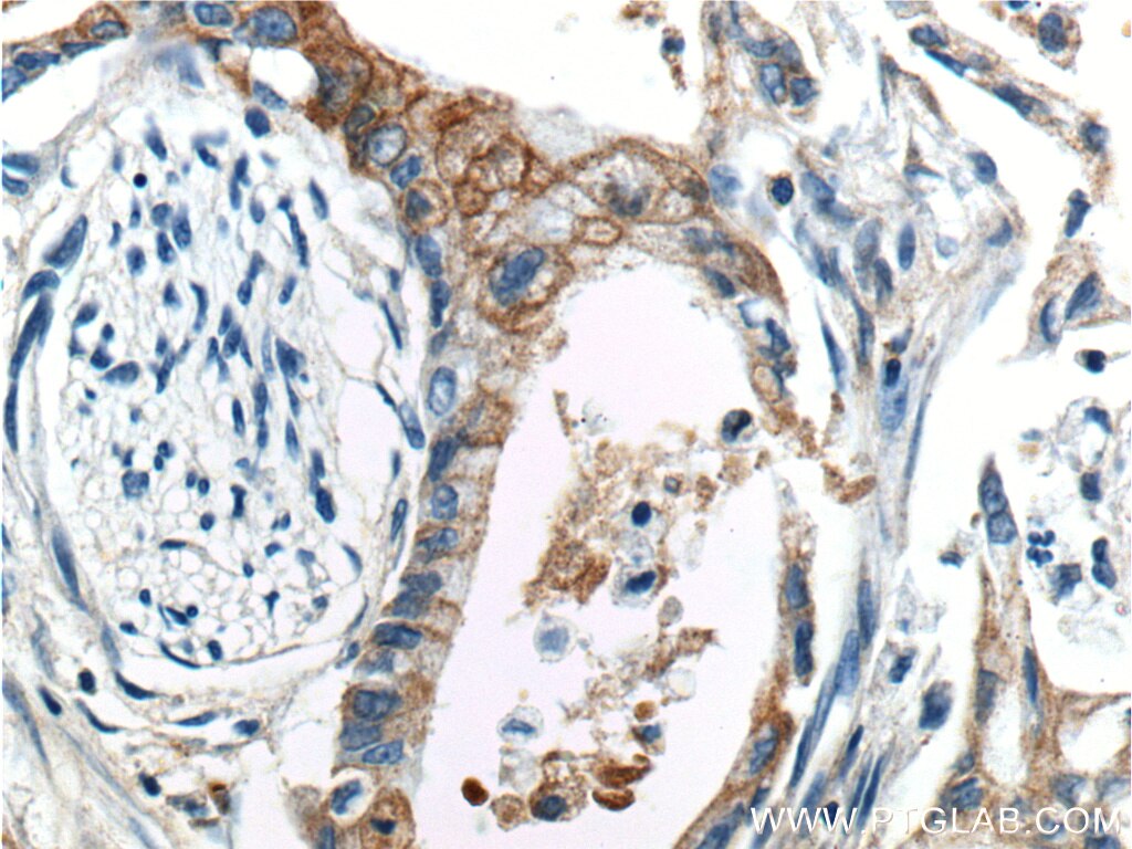 IHC staining of human pancreas cancer using 20259-1-AP