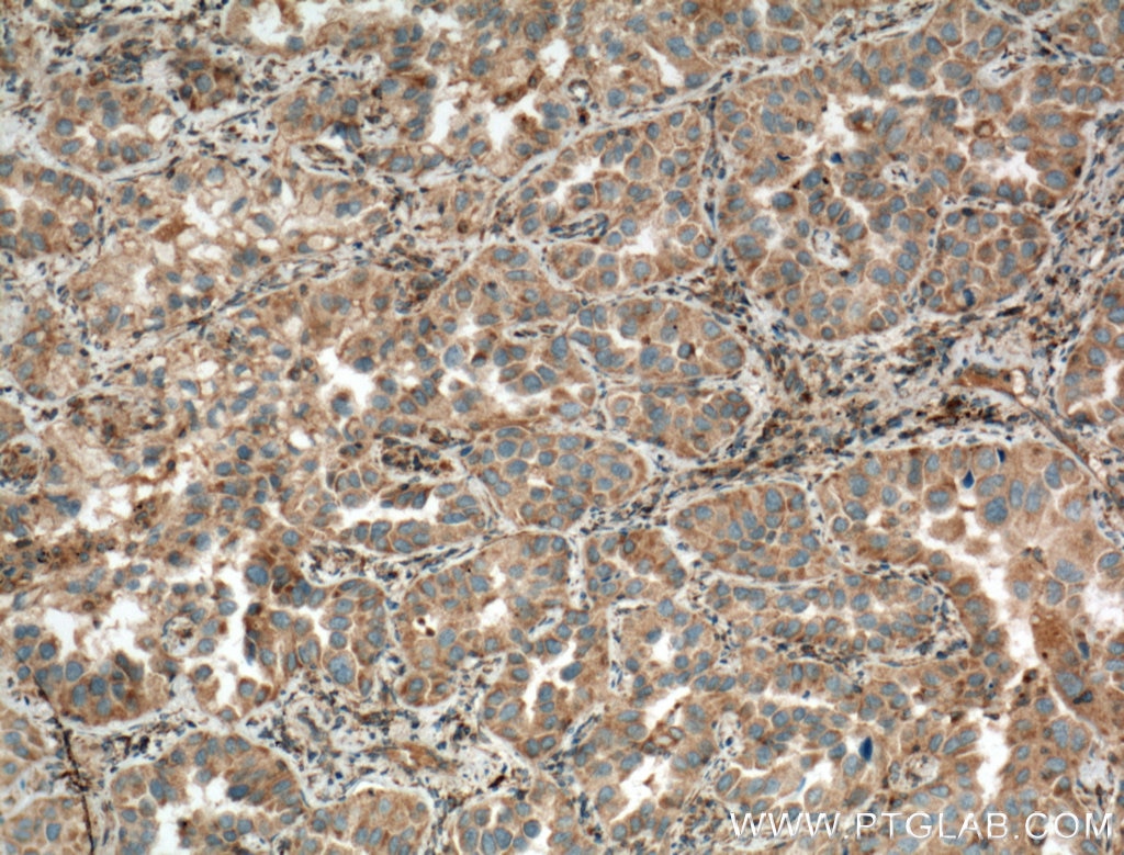 Immunohistochemistry (IHC) staining of human lung cancer tissue using ADAM21 Polyclonal antibody (21434-1-AP)
