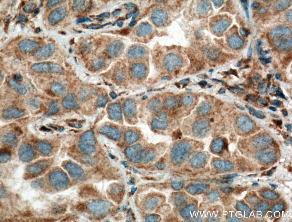 Immunohistochemistry (IHC) staining of human lung cancer tissue using ADAM21 Polyclonal antibody (21434-1-AP)