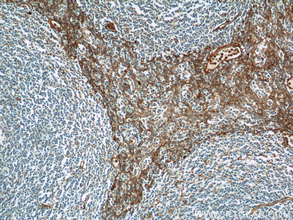 Immunohistochemistry (IHC) staining of human tonsillitis tissue using ADAM8 Polyclonal antibody (23778-1-AP)