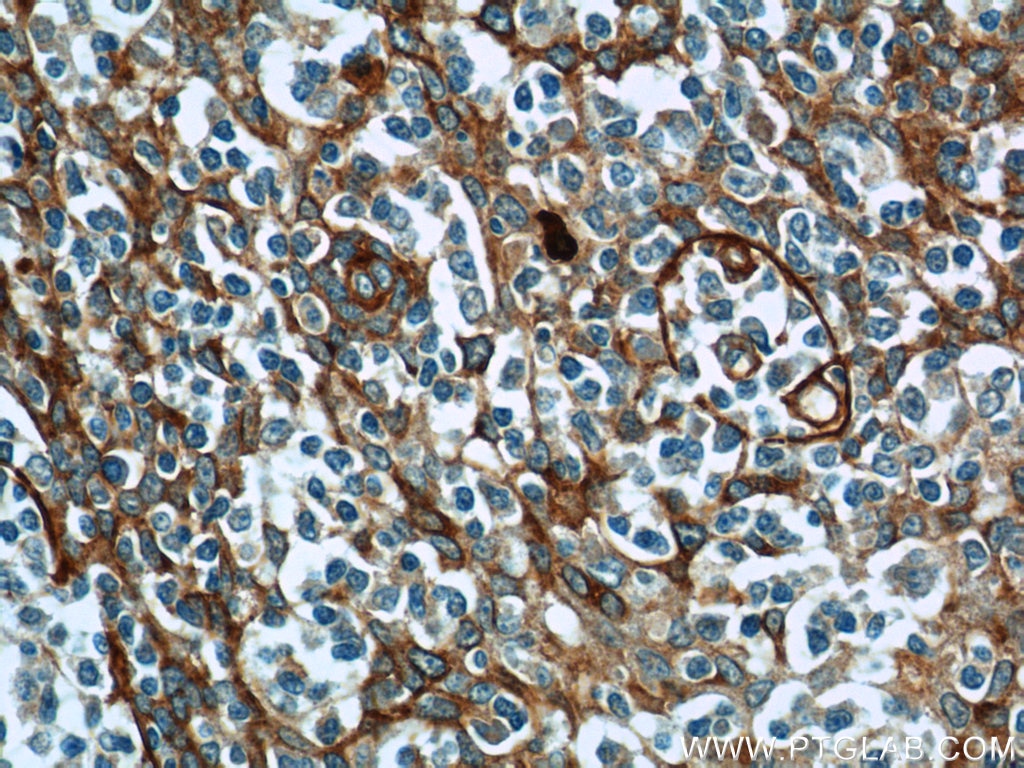 Immunohistochemistry (IHC) staining of human tonsillitis tissue using ADAM8 Polyclonal antibody (23778-1-AP)