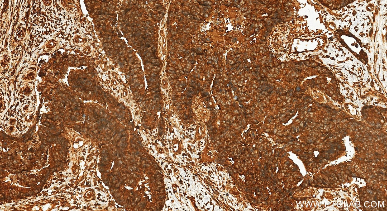 Immunohistochemistry (IHC) staining of human colon cancer tissue using ADAMDEC1 Polyclonal antibody (17899-1-AP)