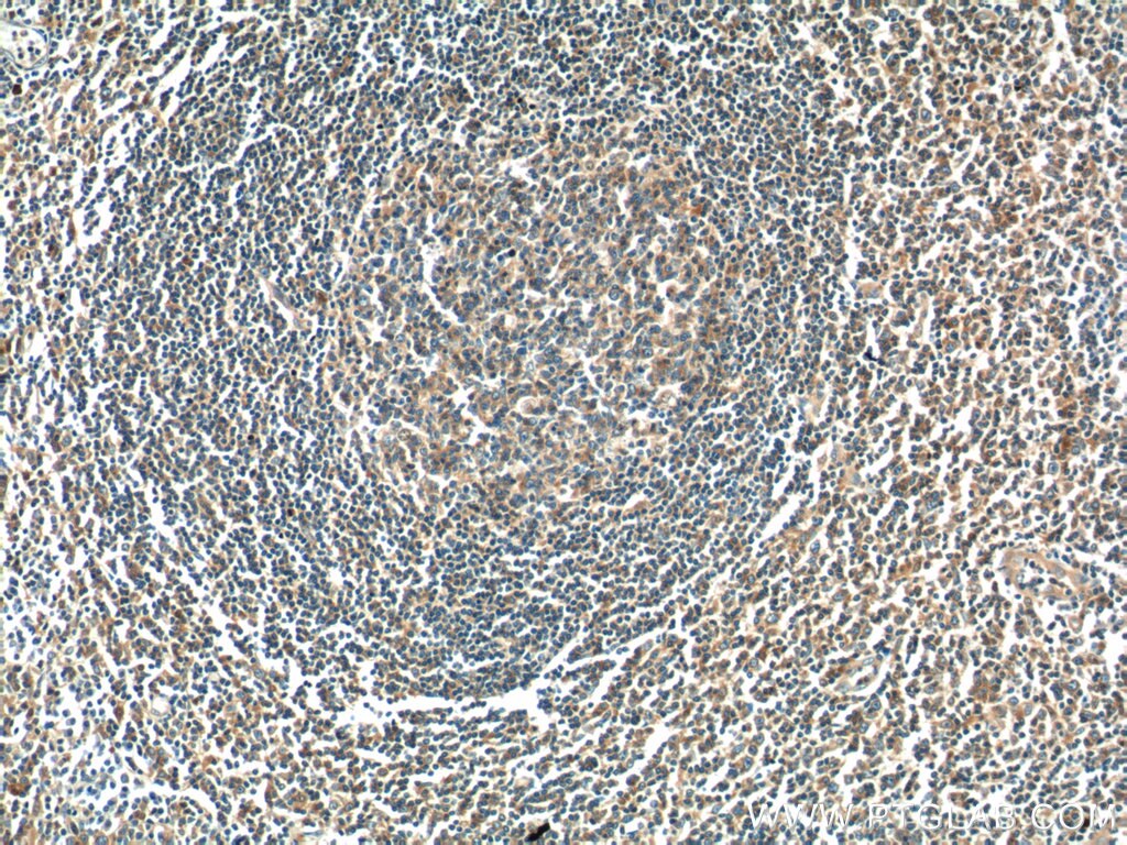 IHC staining of human tonsillitis using 17899-1-AP