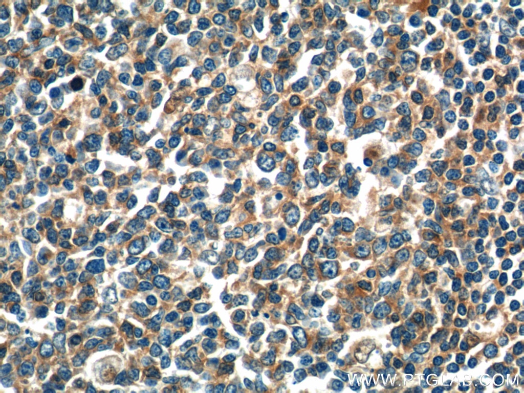 Immunohistochemistry (IHC) staining of human tonsillitis tissue using ADAMDEC1 Polyclonal antibody (17899-1-AP)