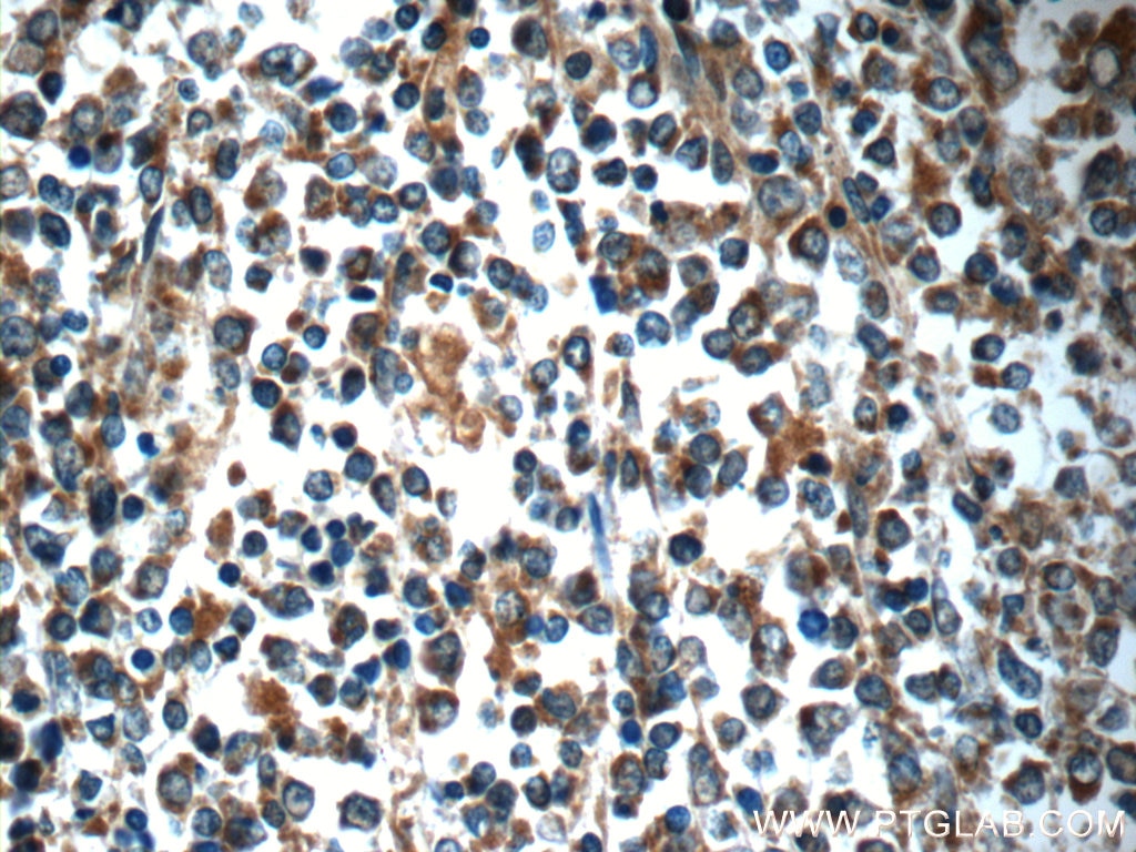 Immunohistochemistry (IHC) staining of human lymphoma tissue using ADAMDEC1 Polyclonal antibody (17899-1-AP)