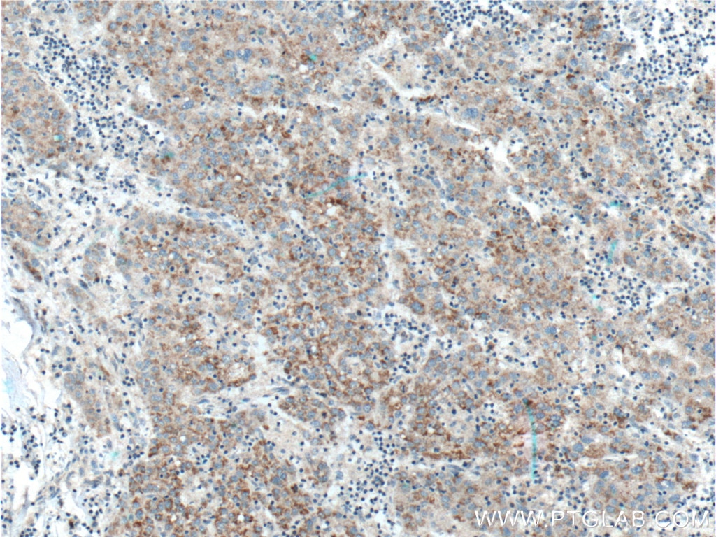 Immunohistochemistry (IHC) staining of human liver cancer tissue using ADAMTS1 Polyclonal antibody (12749-1-AP)