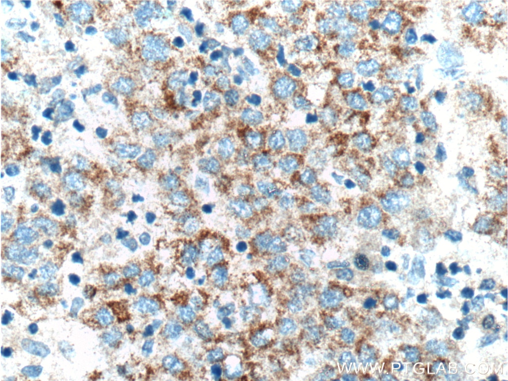 Immunohistochemistry (IHC) staining of human liver cancer tissue using ADAMTS1 Polyclonal antibody (12749-1-AP)