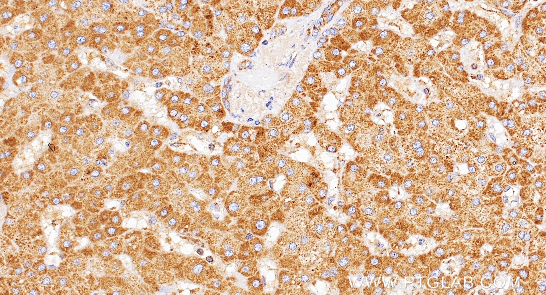 IHC staining of human liver using 98468-2-RR (same clone as 98468-2-PBS) Immunohistochemistry (IHC) staining of human liver tissue using Anti-Human ADAMTS13 Rabbit Recombinant Antibody (98468-2-RR)