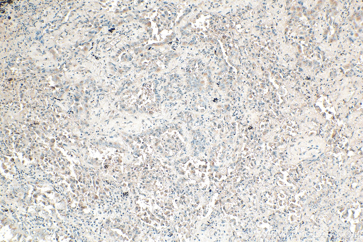 Immunohistochemistry (IHC) staining of human lung cancer tissue using ADAMTS14 Polyclonal antibody (31075-1-AP)