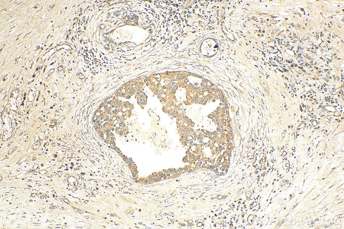 Immunohistochemistry (IHC) staining of human breast cancer tissue using ADAMTS18 Polyclonal antibody (26839-1-AP)