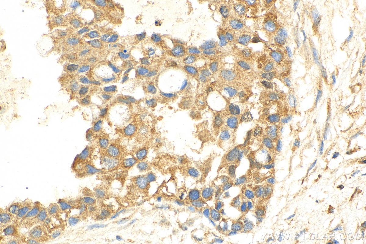 Immunohistochemistry (IHC) staining of human breast cancer tissue using ADAMTS18 Polyclonal antibody (26839-1-AP)