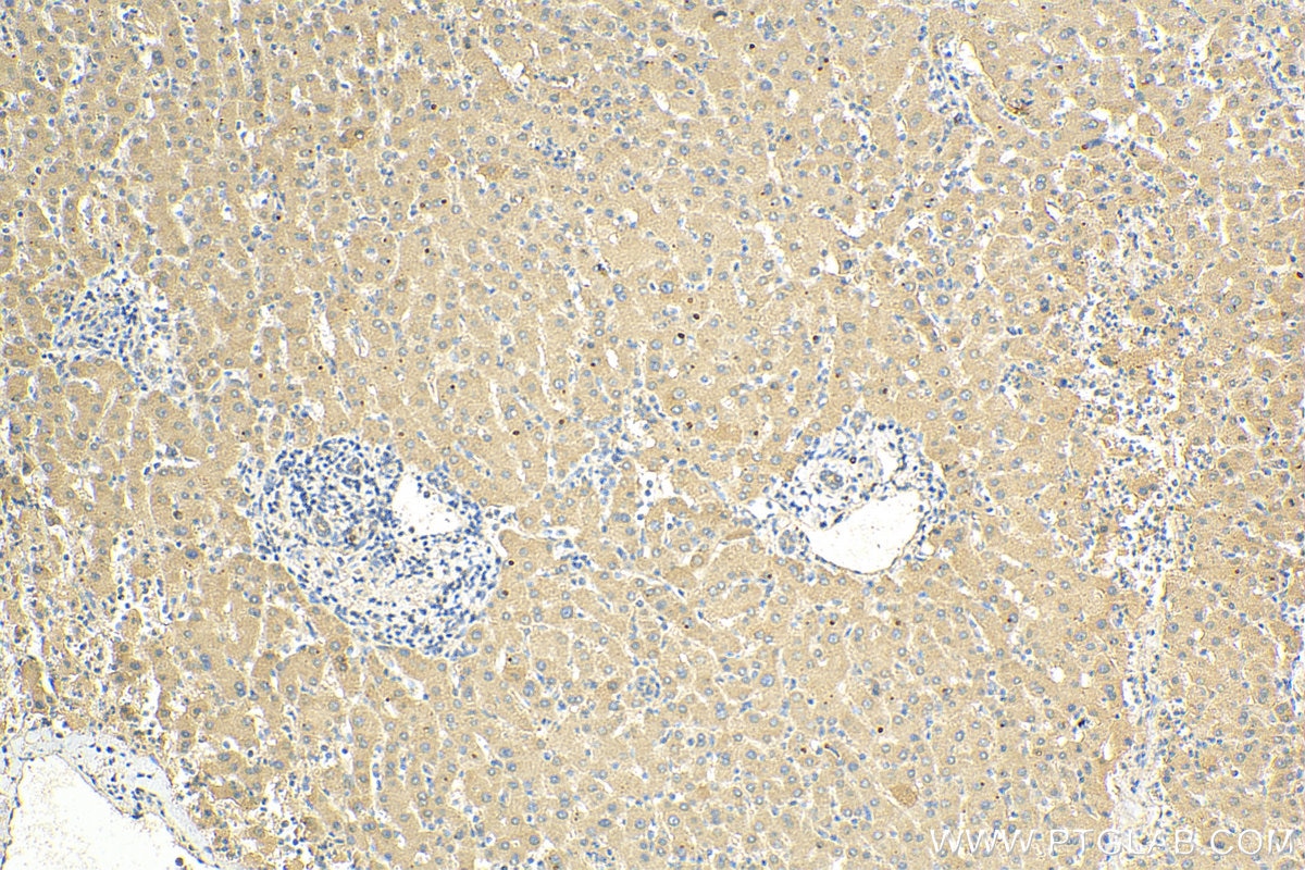 Immunohistochemistry (IHC) staining of human liver cancer tissue using ADAMTS18 Polyclonal antibody (26839-1-AP)