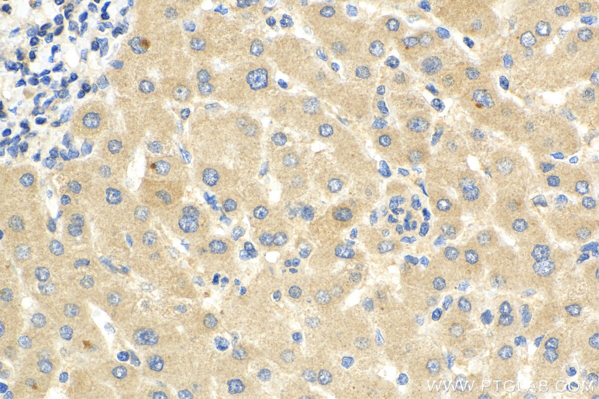 IHC staining of human liver cancer using 26839-1-AP