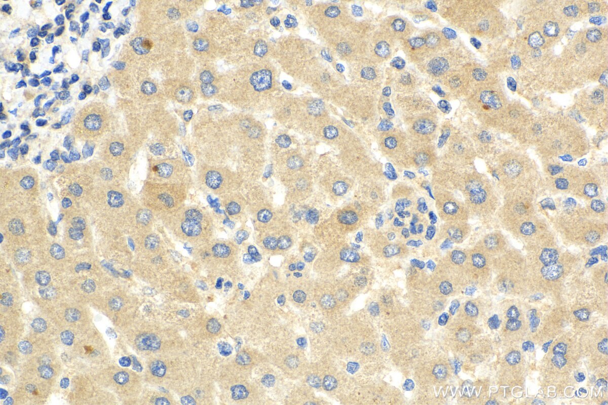 Immunohistochemistry (IHC) staining of human liver cancer tissue using ADAMTS18 Polyclonal antibody (26839-1-AP)