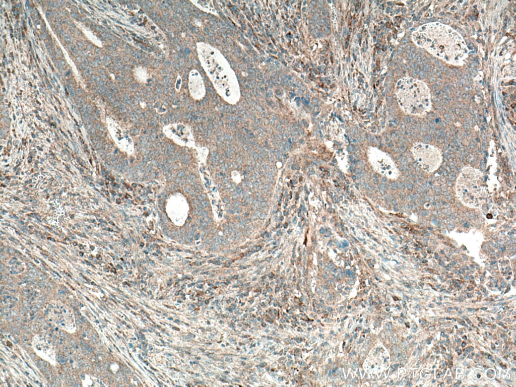 Immunohistochemistry (IHC) staining of human colon cancer tissue using ADAMTS4 Polyclonal antibody (11865-1-AP)