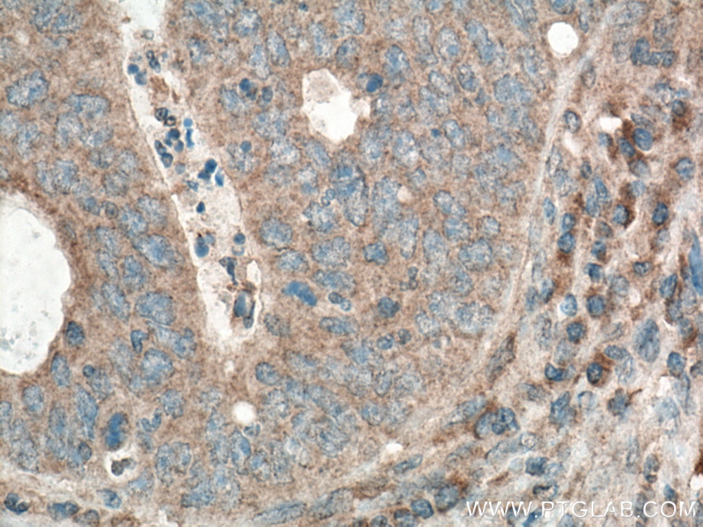 IHC staining of human colon cancer using 11865-1-AP