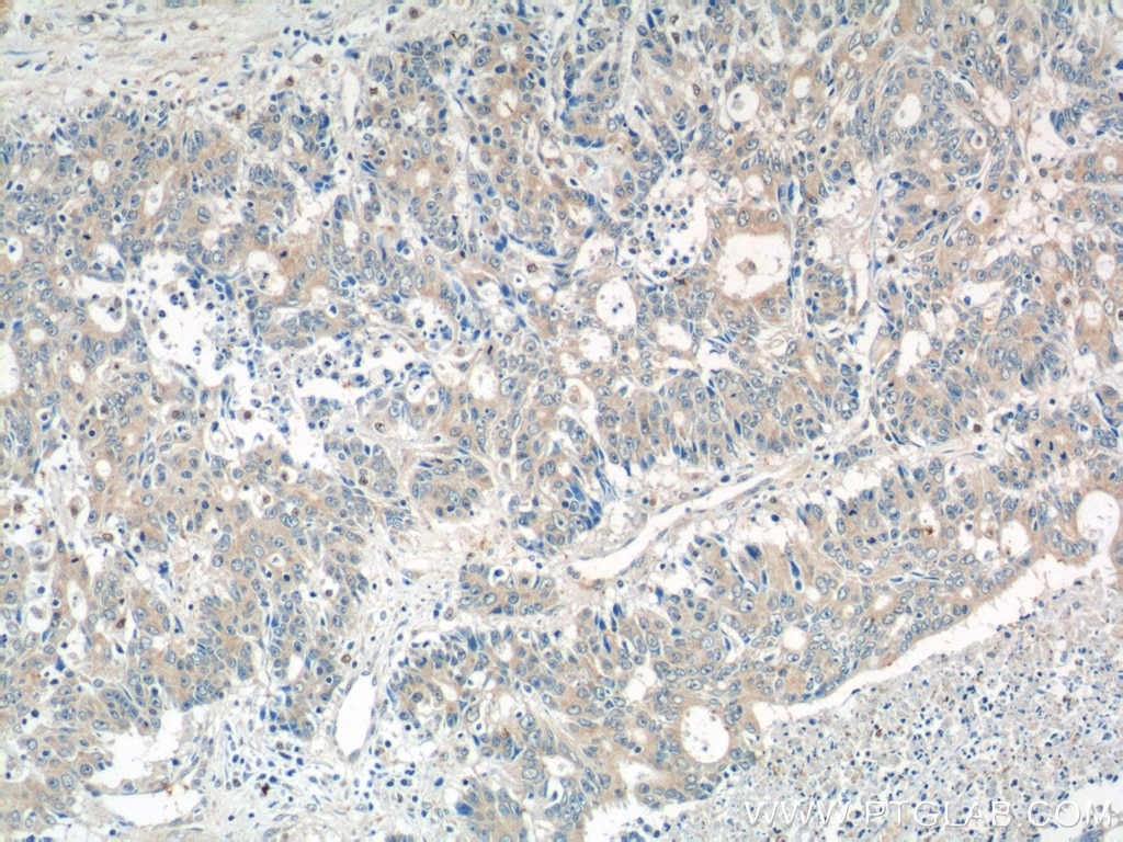 Immunohistochemistry (IHC) staining of human colon cancer tissue using ADAMTSL4 Polyclonal antibody (15304-1-AP)