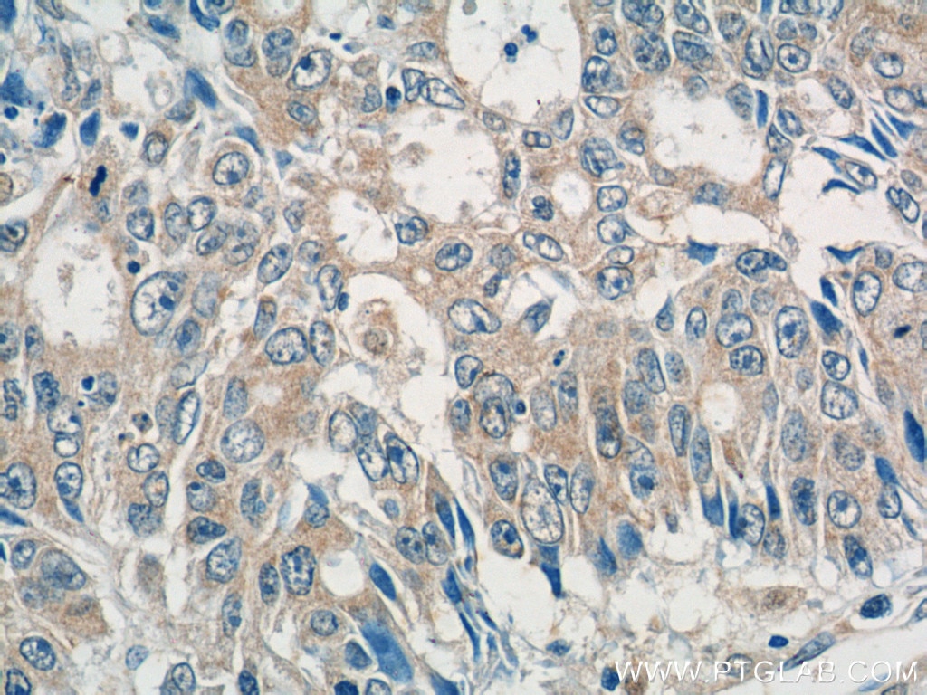Immunohistochemistry (IHC) staining of human colon cancer tissue using ADAMTSL4 Polyclonal antibody (15304-1-AP)