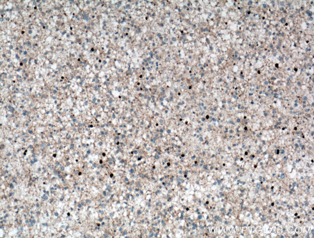 Immunohistochemistry (IHC) staining of human gliomas tissue using ADAP1 Polyclonal antibody (13911-1-AP)