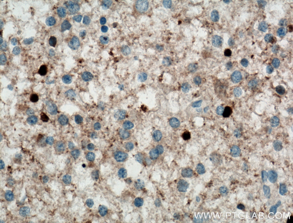 Immunohistochemistry (IHC) staining of human gliomas tissue using ADAP1 Polyclonal antibody (13911-1-AP)