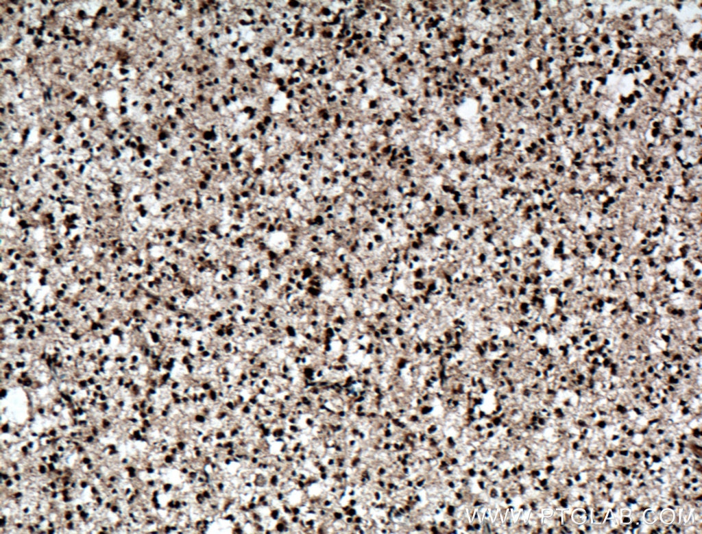 Immunohistochemistry (IHC) staining of human gliomas tissue using ADAR1 Polyclonal antibody (14330-1-AP)