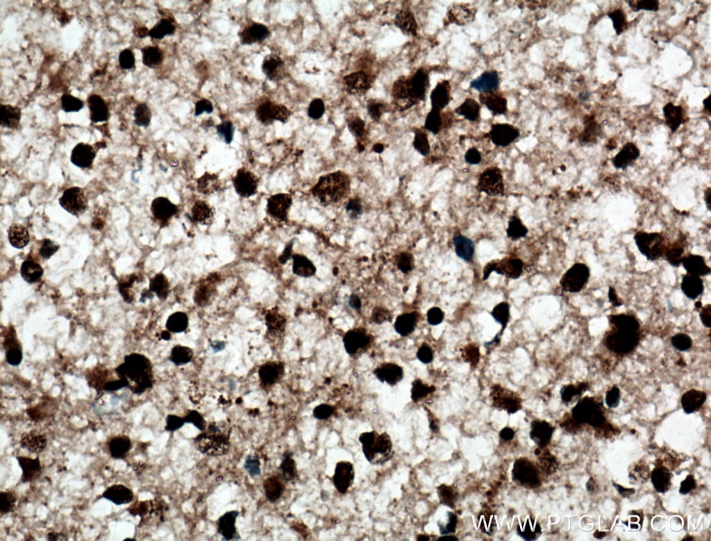 Immunohistochemistry (IHC) staining of human gliomas tissue using ADAR1 Polyclonal antibody (14330-1-AP)