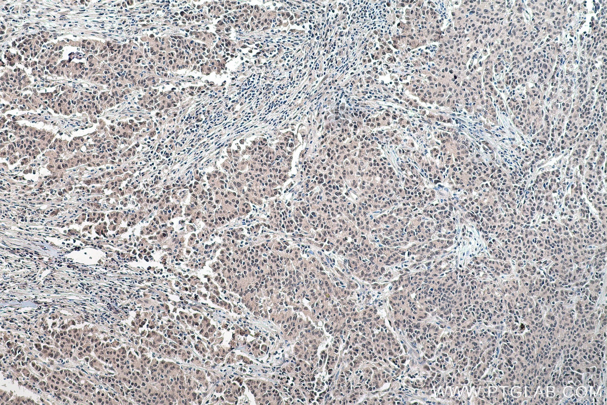 Immunohistochemistry (IHC) staining of human stomach cancer tissue using ADAR1 Polyclonal antibody (14330-1-AP)