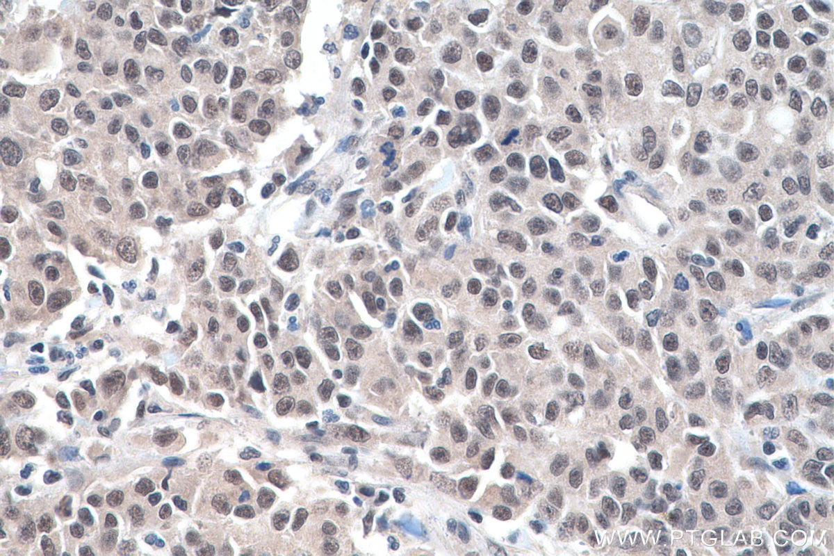 Immunohistochemistry (IHC) staining of human stomach cancer tissue using ADAR1 Polyclonal antibody (14330-1-AP)