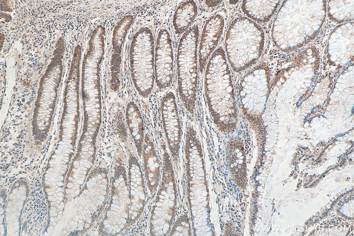 IHC staining of human colon cancer using 14330-1-AP