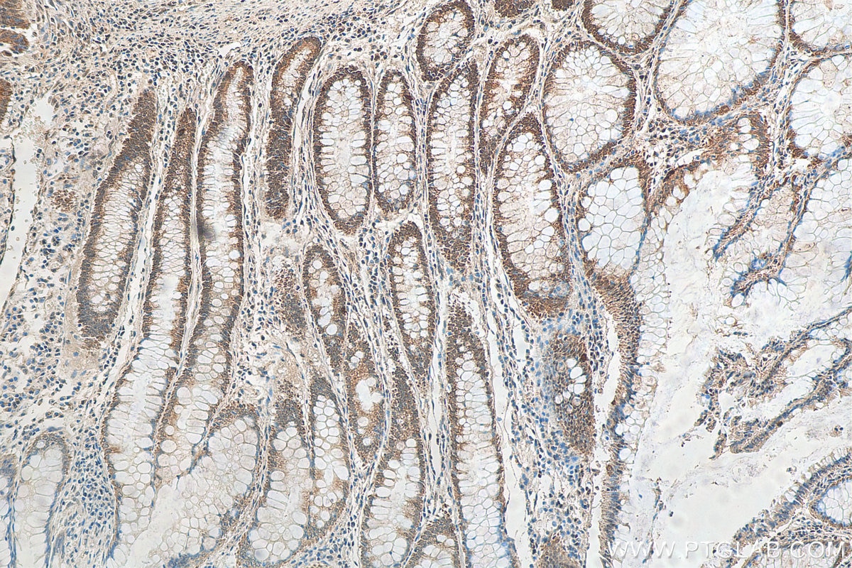 Immunohistochemistry (IHC) staining of human colon cancer tissue using ADAR1 Polyclonal antibody (14330-1-AP)