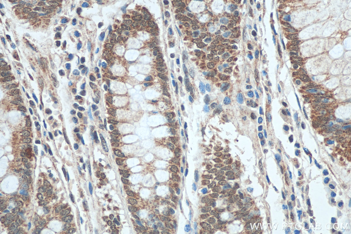Immunohistochemistry (IHC) staining of human colon cancer tissue using ADAR1 Polyclonal antibody (14330-1-AP)