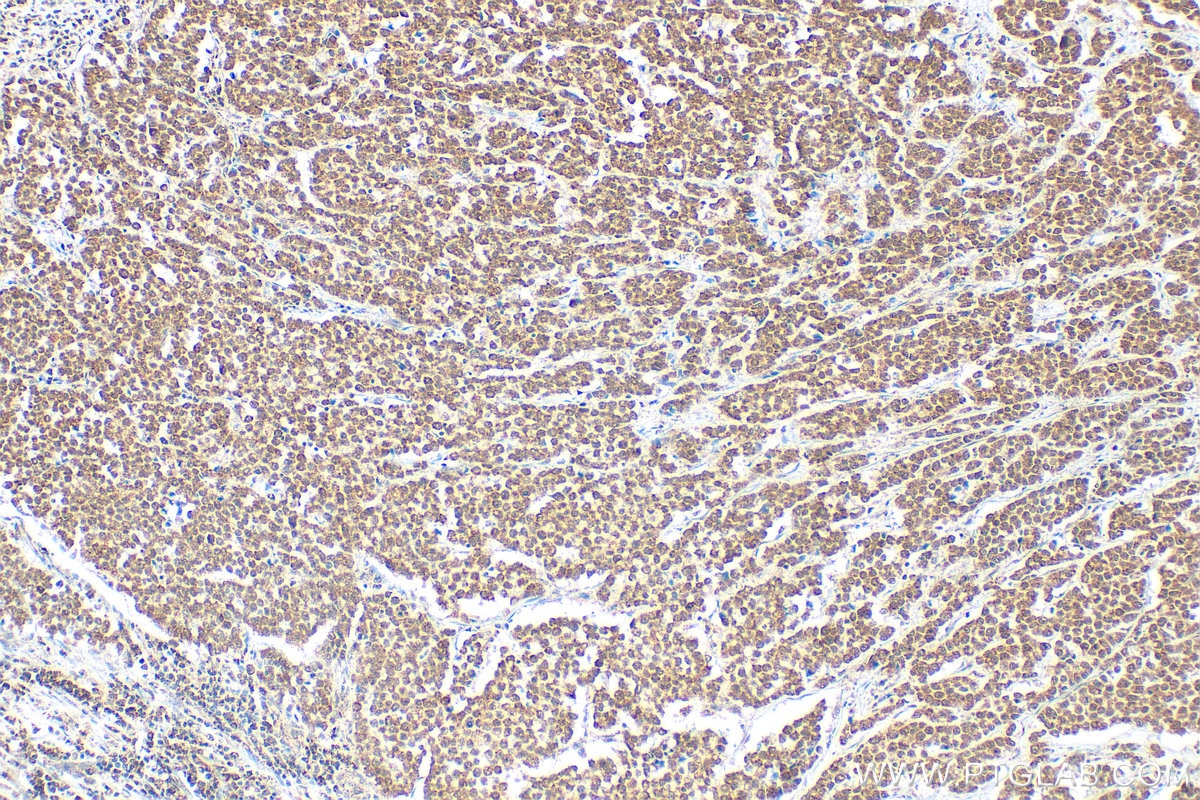 Immunohistochemical analysis of paraffin-embedded human colon cancer tissue slide using 14330-1-AP (ADAR1 antibody) at dilution of 1:200 (under 10x lens). Heat mediated antigen retrieval with Tris-EDTA buffer (pH 9.0). Immunohistochemistry (IHC) staining of human colon cancer tissue using ADAR1 Polyclonal antibody (14330-1-AP)