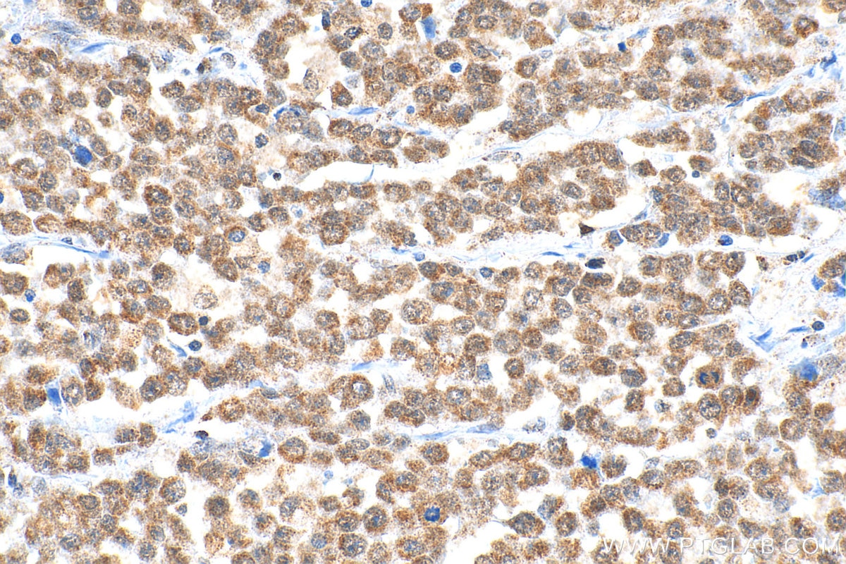 Immunohistochemical analysis of paraffin-embedded human colon cancer tissue slide using 14330-1-AP (ADAR1 antibody) at dilution of 1:200 (under 40x lens). Heat mediated antigen retrieval with Tris-EDTA buffer (pH 9.0). Immunohistochemistry (IHC) staining of human colon cancer tissue using ADAR1 Polyclonal antibody (14330-1-AP)