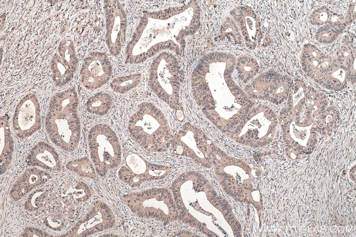 Immunohistochemistry (IHC) staining of human colon cancer tissue using ADAT2 Polyclonal antibody (13621-1-AP)