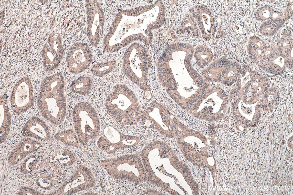 IHC staining of human colon cancer using 13621-1-AP