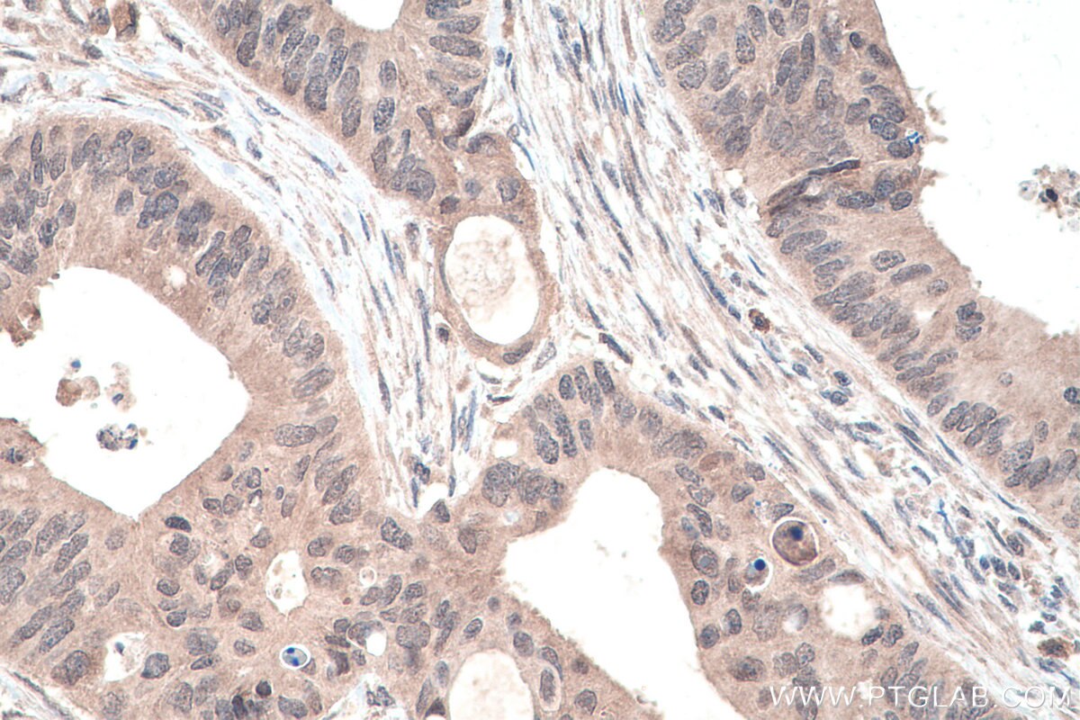 IHC staining of human colon cancer using 13621-1-AP