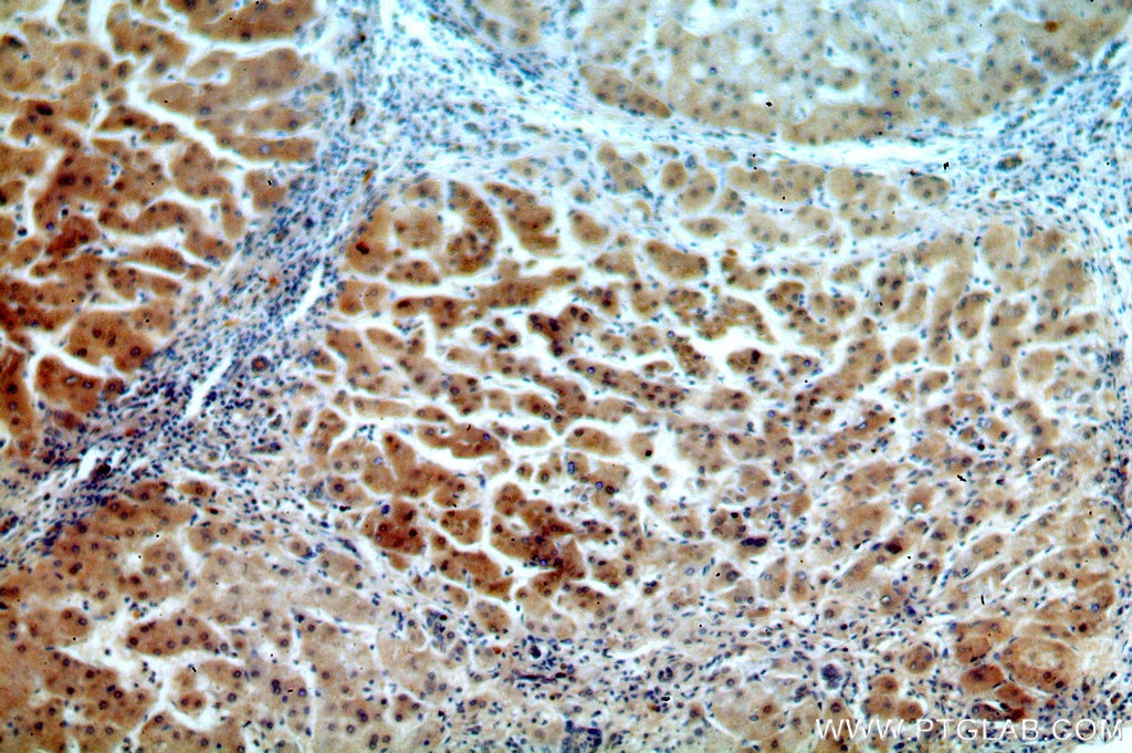 Immunohistochemistry (IHC) staining of human hepatocirrhosis tissue using ADAT2 Polyclonal antibody (13621-1-AP)
