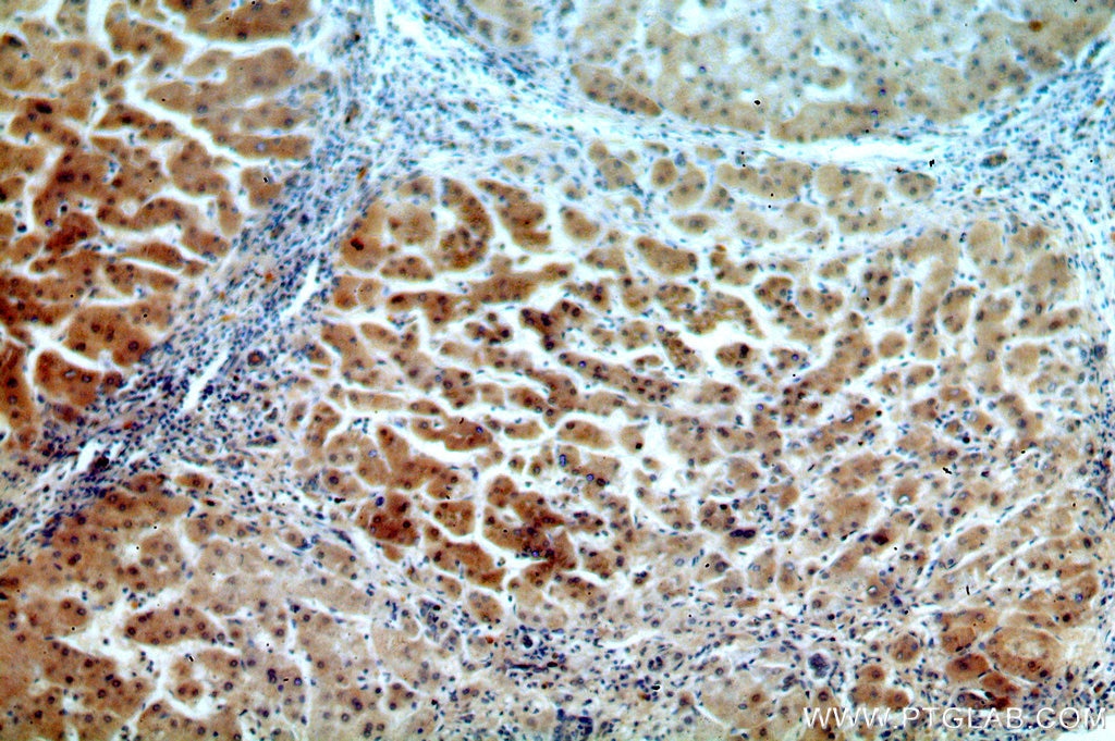 IHC staining of human hepatocirrhosis using 13621-1-AP